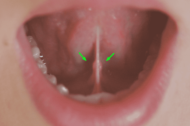 cannabis oil consumption - under the tongue